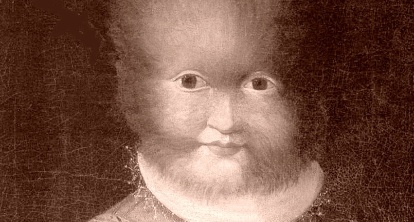 Alterazioni dell’aspetto fisico dovuto alle “malattie rare” alle origini della figura del mazapégul ?